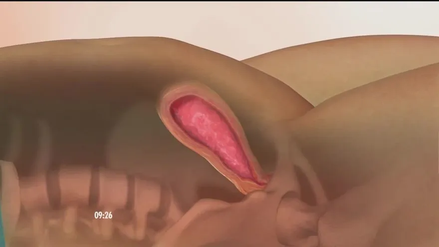 ¿Qué hacer si se presentan sangrado después de dar a luz?