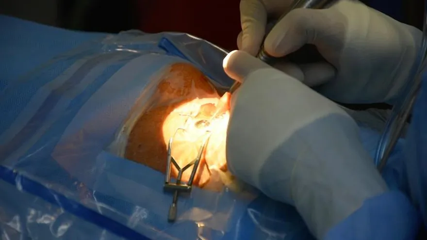 ¡Cataratón llega a Bocas del Toro! 50 cirugías se realizarán este fin de semana