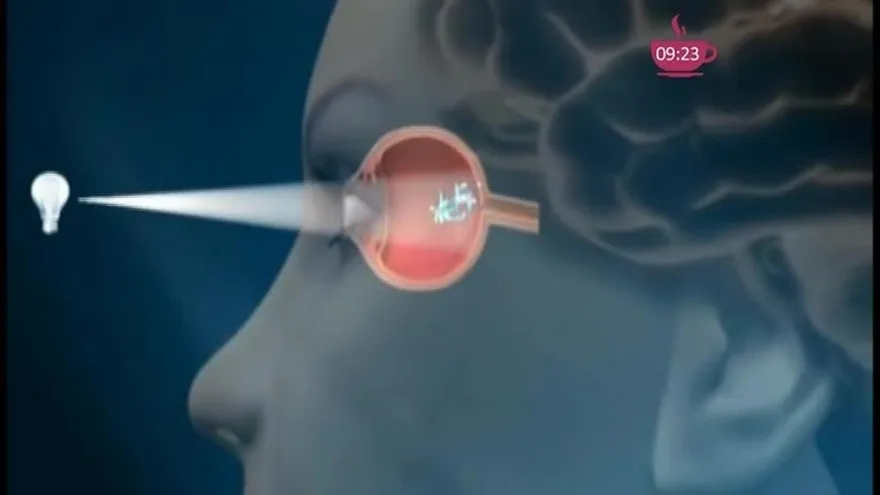 El Glaucoma causa ceguerea irreversible si no es tratada a tiempo