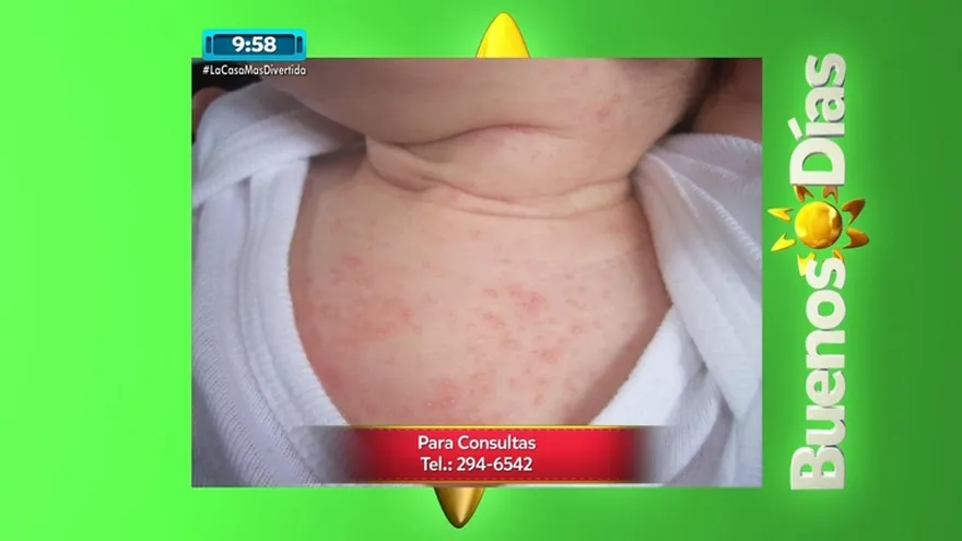 Sarpullido en los bebes