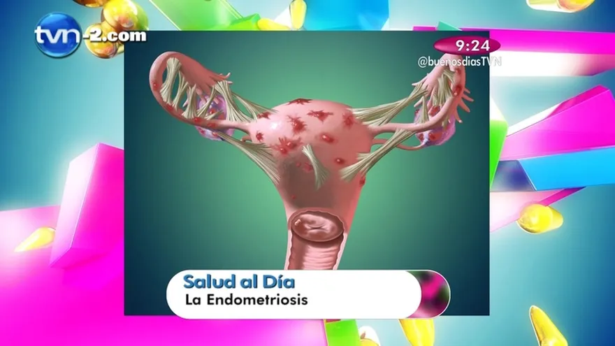 Segmento Salud al Día " La Endometriosis"