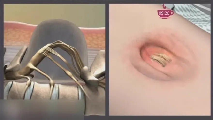 Espina Bífida: segunda causa más común de malformaciones en Panamá