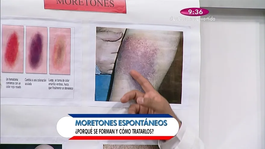 Salud al Día - Te hablaremos de  los moretones espontáneos  en diferentes partes del cuerpo porque se forman y cómo tratarlos