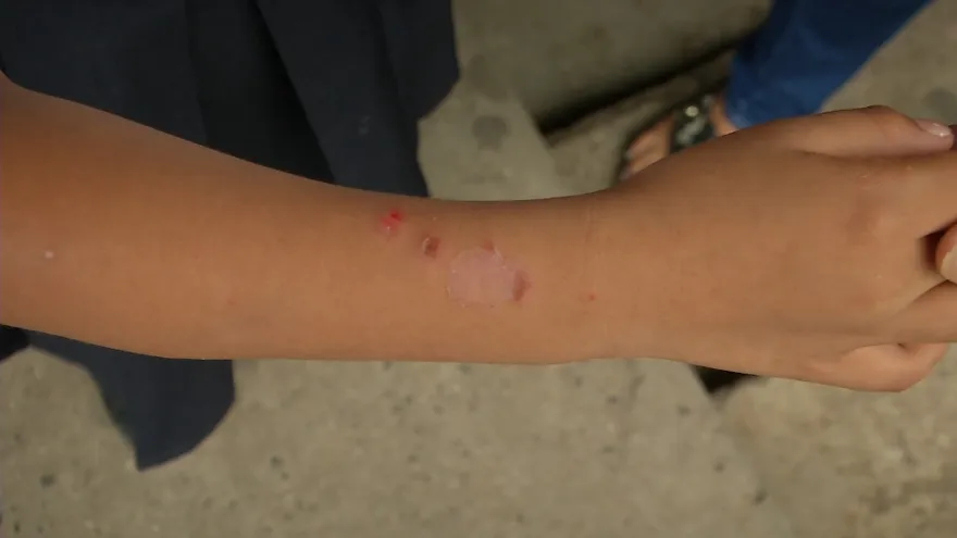 Brote de sarna en escuela de Las Mañanitas