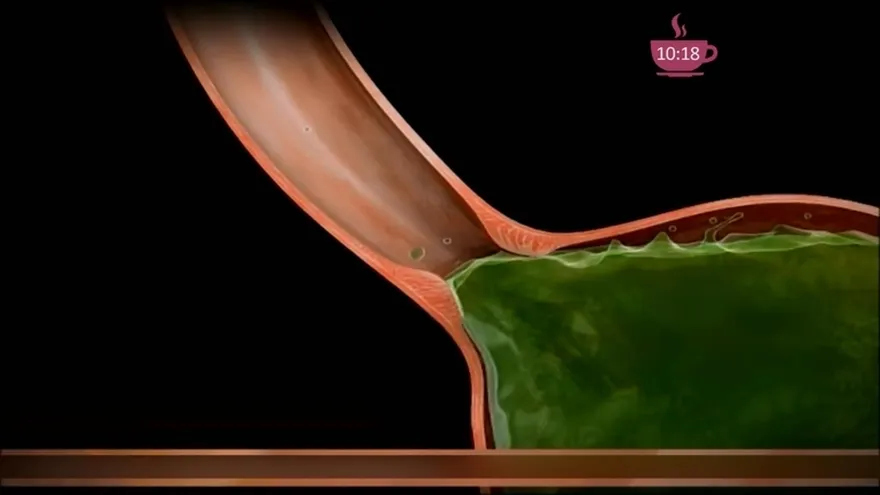 Acidez estomacal cómo atacarla y prevenirla