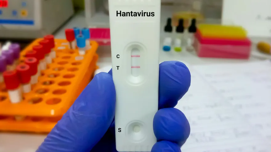 Test de Hantavirus.