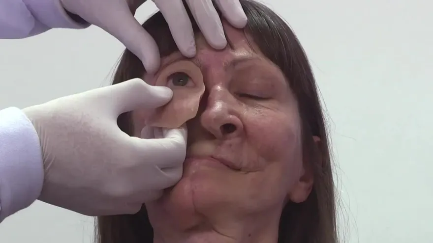 Prótesis de bajo costo para sobrevivientes de cáncer en Brasil