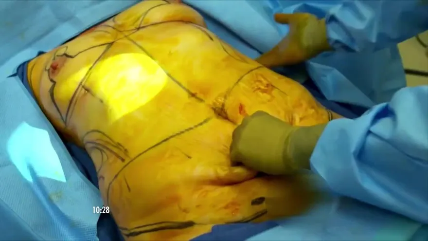 Sanciones por procedimientos estéticos ilegales