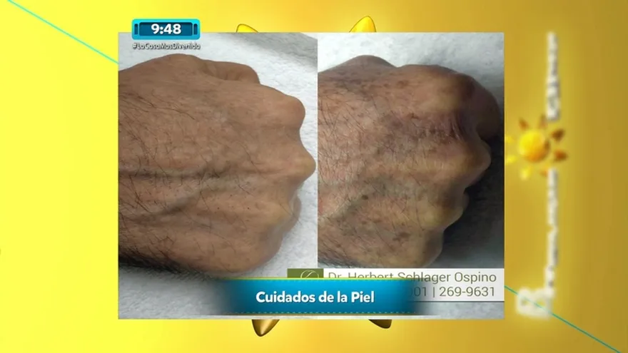 Daños que nos puede ocasionar al no cuidar la piel del sol