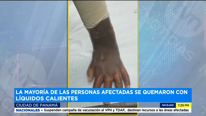 Aumentan los casos de quemados con líquido caliente y por el mal uso del alcohol.