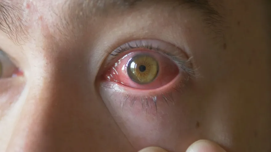 Conjuntivitis dispara alertas en San Miguelito: Más de 500 casos y subiendo ¿Qué la provoca?