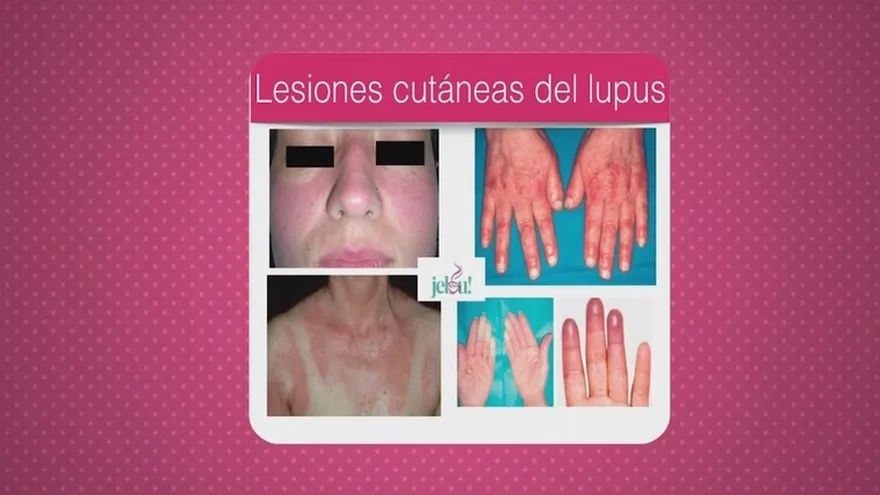 Conoce sobre la enfermedad  Lupus, sus síntomas, causas y quienes son los más propensos.
