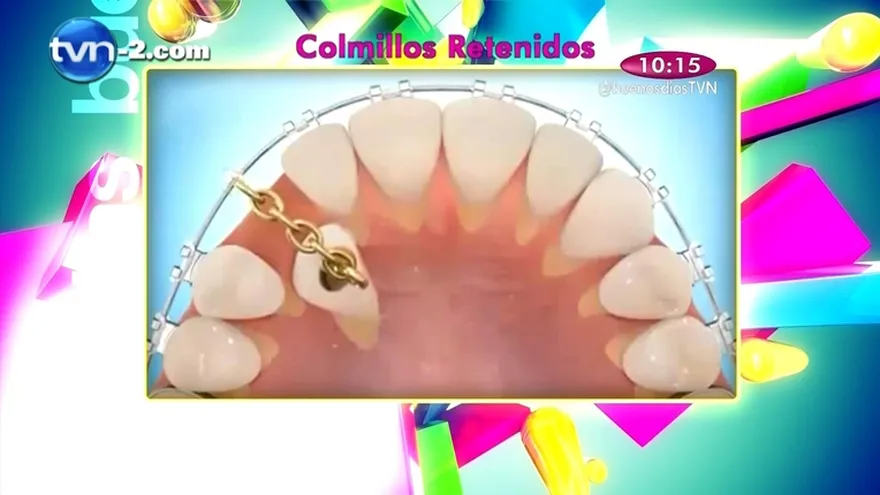 Salud Dental - Colmillos Retenidos