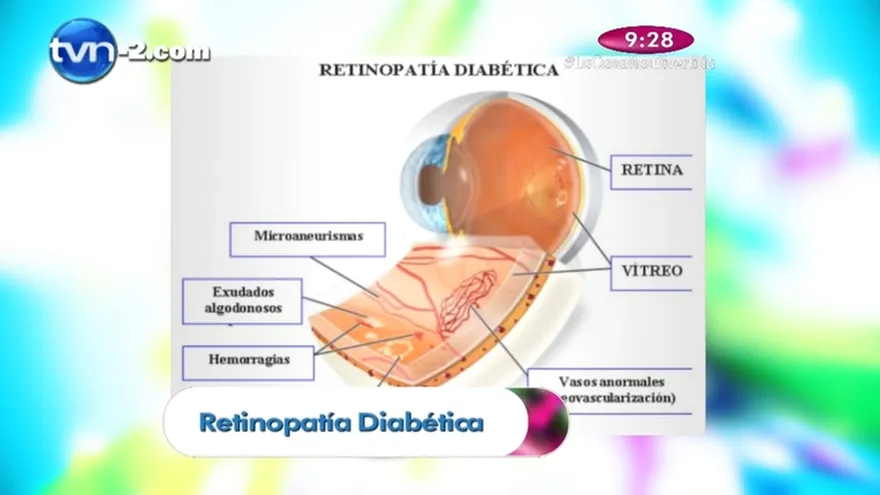 Salud al día - Sabes que es la de  la Retinopatía Diabética  un especialista  nos  hablará de esta enfermedad muy frecuente