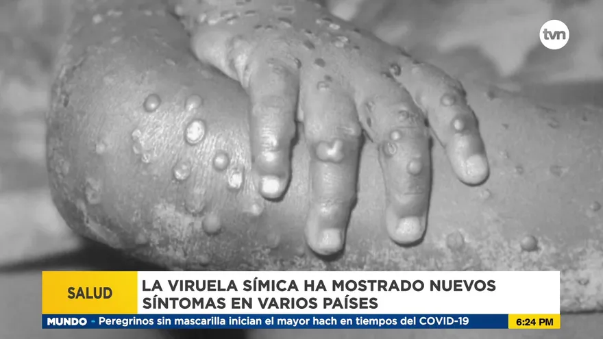 Nuevos síntomas para la viruela del mono