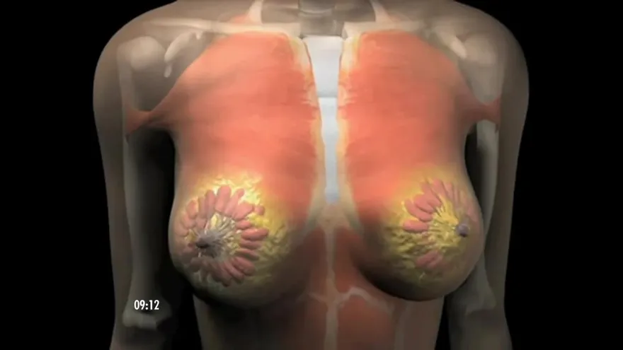 Cómo detectar el cáncer de mama a tiempo