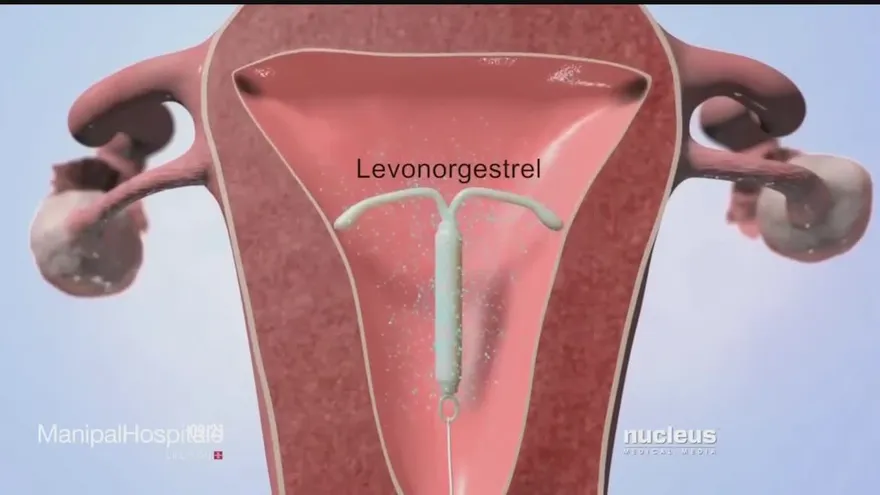 Mitos, verdades, consecuencias y riesgos de la T de cobre para evitar embarazos.