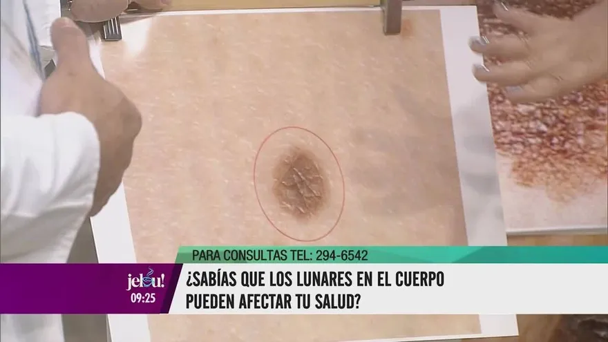 Detecta si los lunares en tu piel pueden ser cancerígenos