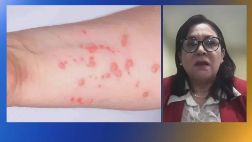 ¿Qué controles aplica el Minsa contra la viruela del mono?