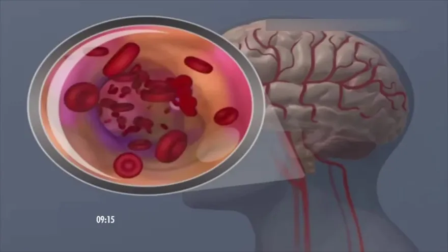 ¿Cuáles son las señales de un inminente derrame cerebral?