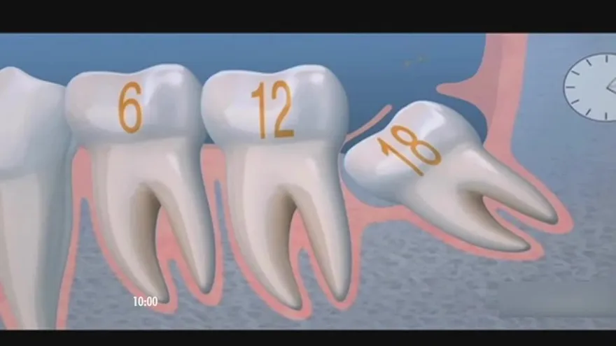 ¿Por qué causan dolor las muelas del juicio?
