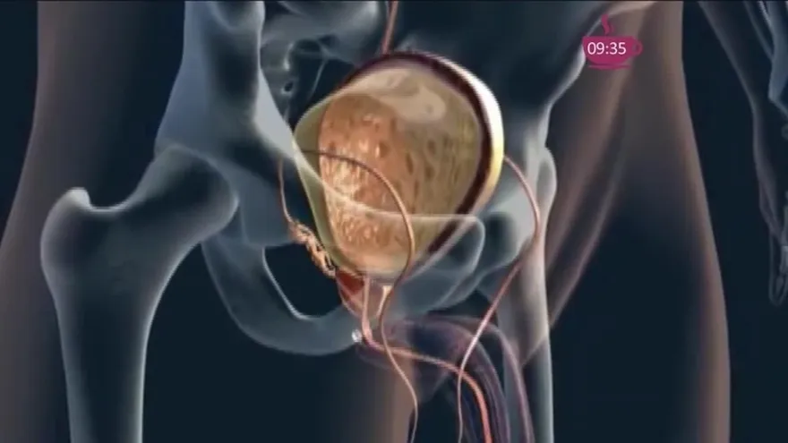 Qué tan grave puede ser la incontinencia urinaria en los hombres