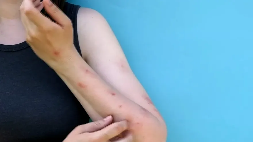 Panamá confirma dos nuevos casos de viruela del mono