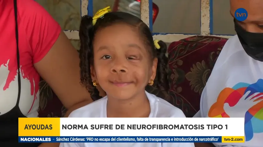 Fundación AYOUDAS se esfuerza por brindar apoyo a la pequeña Norma quien sufre de Neurofibromatosis