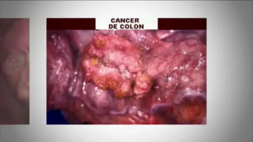 Cuidado con el cáncer de colon