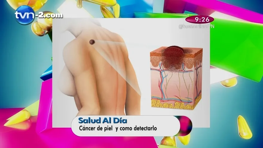 Segmento Salud al Día -  Cáncer de piel, y cómo poder detectarlo