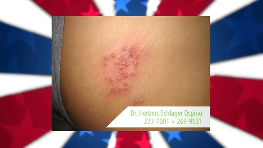 Salud al día -  Herpes en la piel como detectarla y tratarla