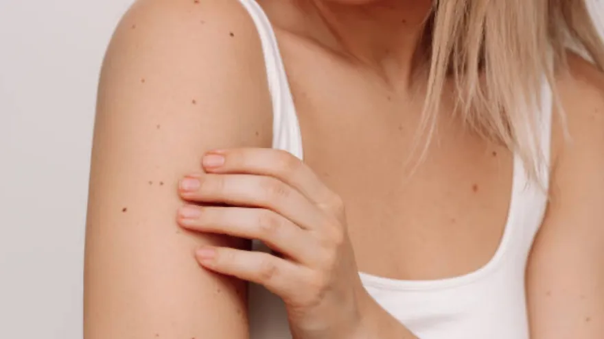 Imágen con fines ilustrativos de lunares