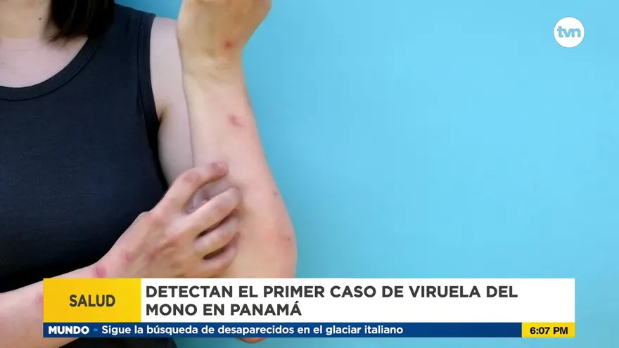Primer paciente con viruela de mono en Panamá