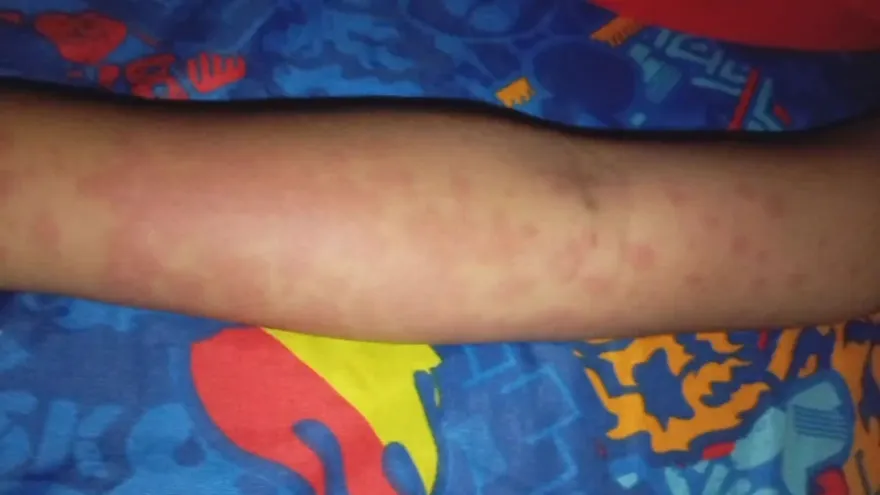 Mysterious Allergy Outbreak Affects Over 20 Students at La Chorrera School