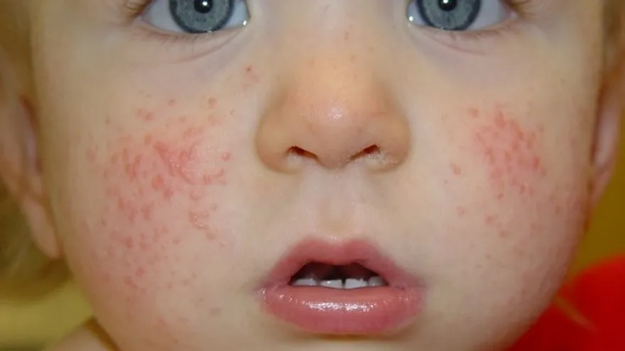 Tiempo de verano, el sarpullido podría aparecer en tu bebe. ¡Conoce como tratarlo!