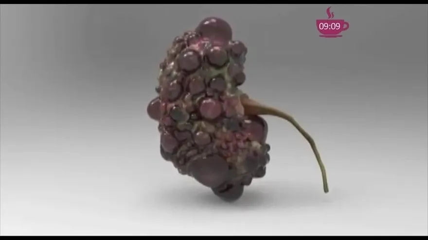 Síndrome del ovario poliquístico ¡Trastorno que afecta a las mujeres!