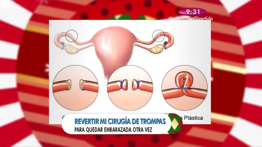 Salud al día - Quiero revertir mi cirugía de trompas para quedar embarazada de nuevo