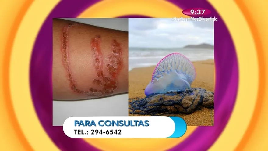 Salud al día - Cómo tratar las picaduras de aguas malas