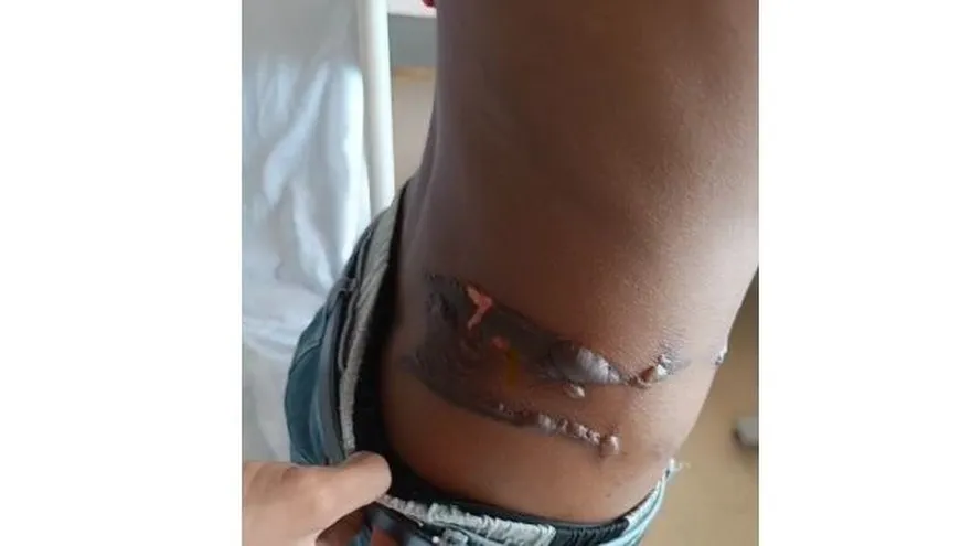 El adolescente sufrió una quemadura durante la limpieza de una herida abdominal en el Hospital Nicolás Solano.