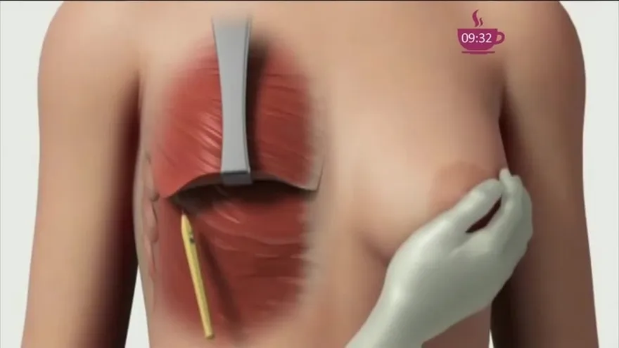 Lo que debes saber sobre la reconstrucción de mamas en Panamá