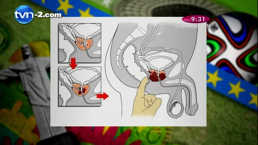 Segmento Salud al Día - Cáncer de Próstata, Diagnóstico y tratamiento