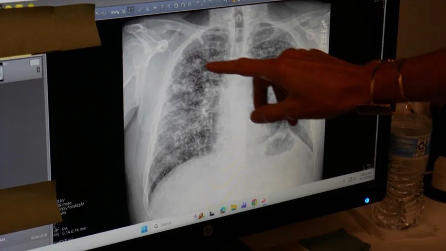 US Coal Miners Suffer Resurgence of 'Black Lung Disease'