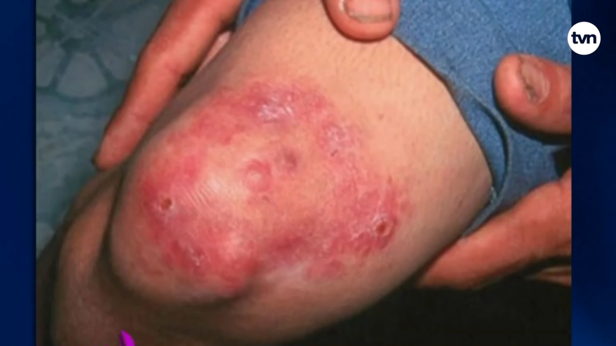 La lepra no está erradicada