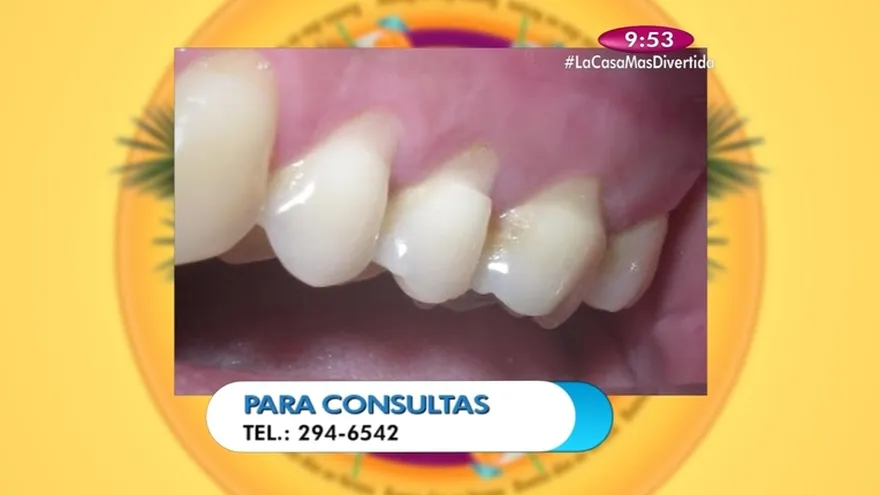 Bruxismo Causa Síntomas y Tratamiento