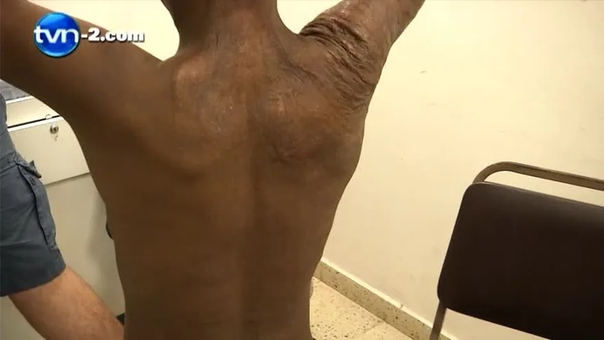 Menos niños quemados con educación