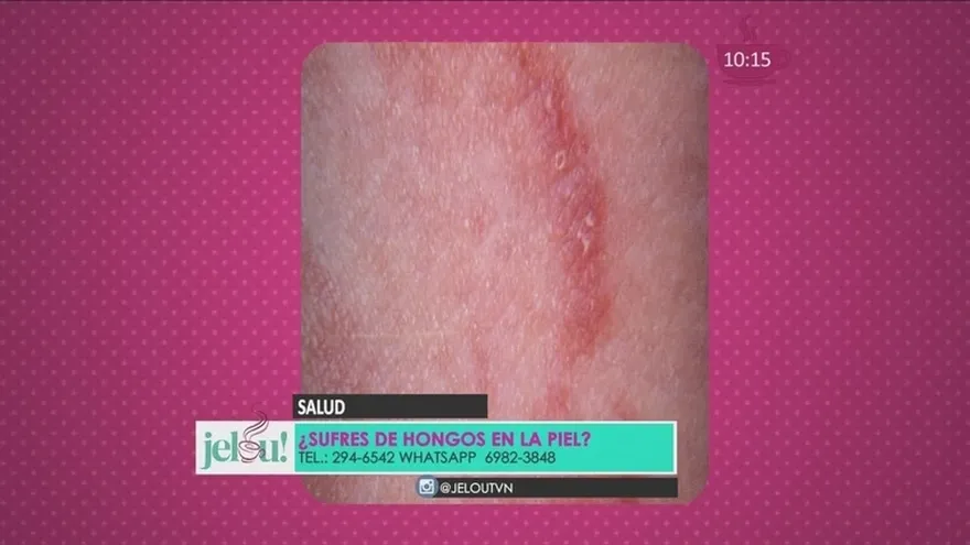 ¡Hongos en la piel! Descubre como tratarlos.