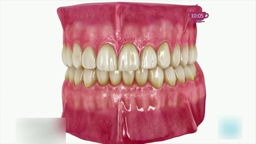 El desgaste dental es un problema más serio de lo que creías