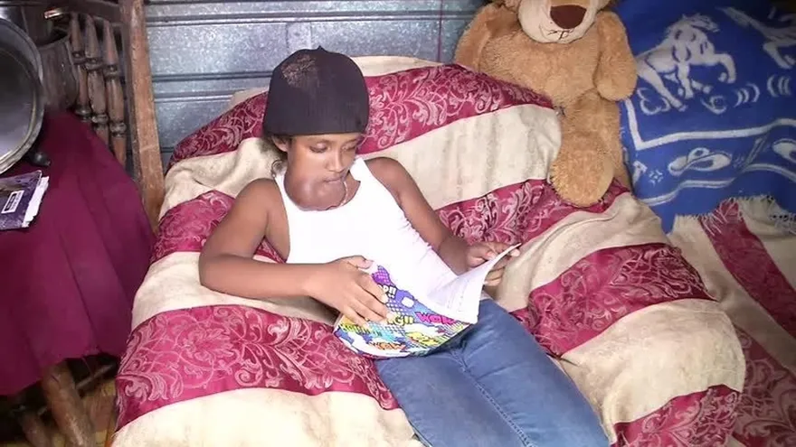 Menor necesita operación por tumor en el rostro