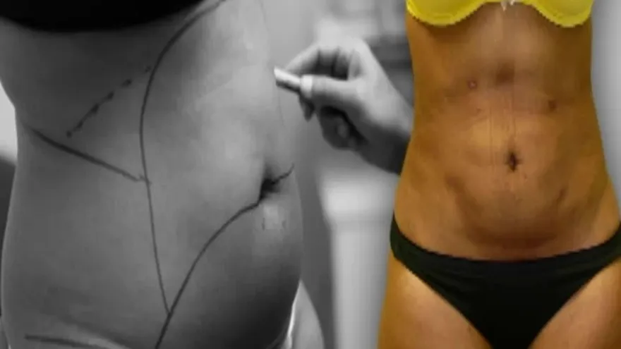 Operaciones estéticas que cuestan la vida