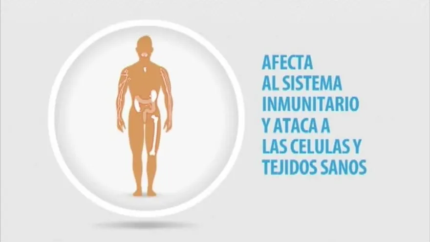 Aumentan casos de Lupus en Panamá